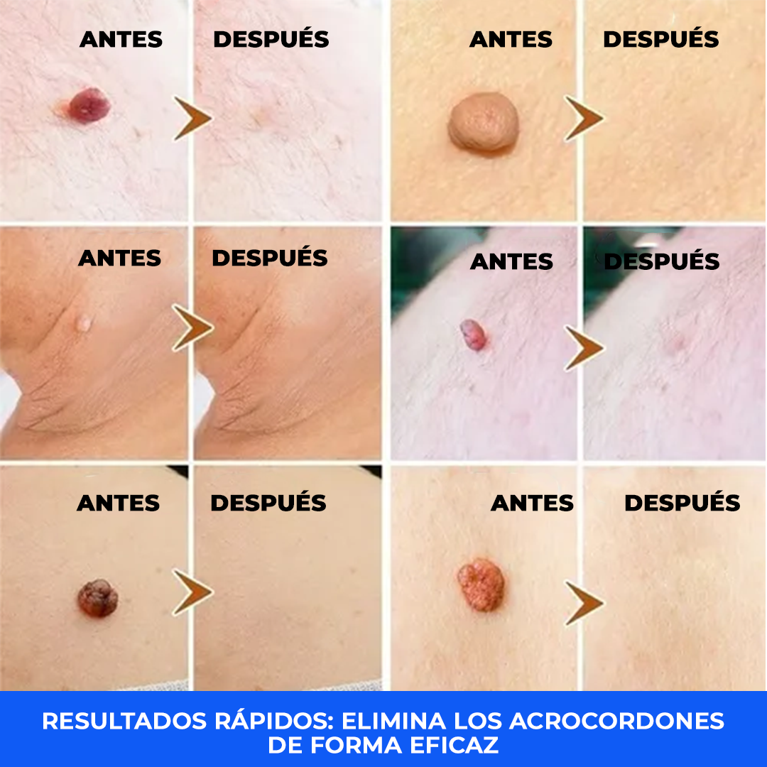 El Eliminador Definitivo de Verrugas - DermaZero + 1 GRATIS (TESTE)
