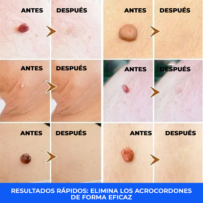 El Eliminador Definitivo de Verrugas - DermaZero + 1 GRATIS (TESTE)