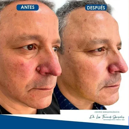 El Eliminador Definitivo de Verrugas - DermaZero + 1 GRATIS