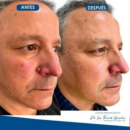 El Eliminador Definitivo de Verrugas - DermaZero + 1 GRATIS