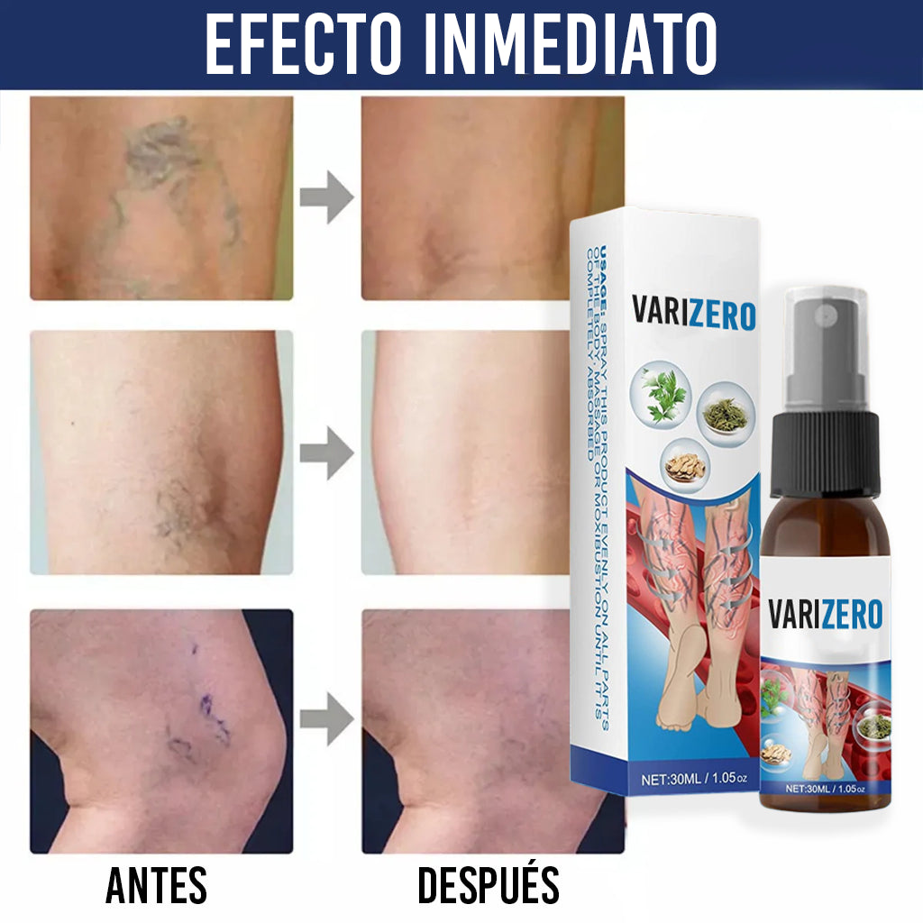 El Spray que Elimina Varices Visibles en Días – VariZero™ + 1 GRATIS