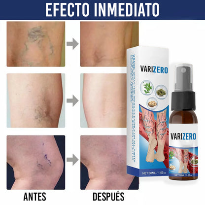 El Spray que Elimina Varices Visibles en Días – VariZero™ + 1 GRATIS