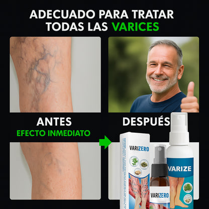 El Spray que Elimina Varices Visibles en Días – VariZero™ + 1 GRATIS
