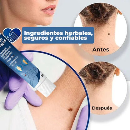 El Eliminador Definitivo de Verrugas - DermaZero + 1 GRATIS