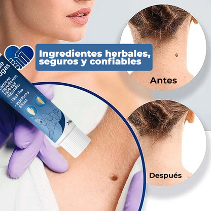 El Eliminador Definitivo de Verrugas - DermaZero + 1 GRATIS (TESTE)