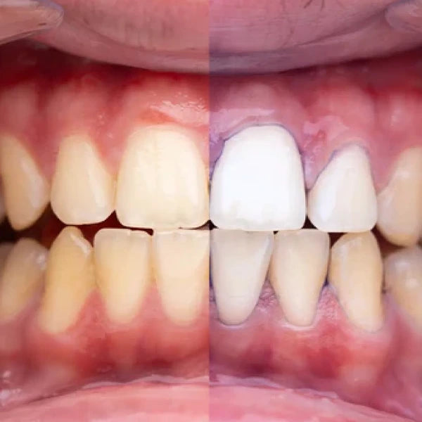 Obsessive –  El Blanqueador Dental Definitivo
