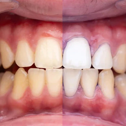 Obsessive –  El Blanqueador Dental Definitivo