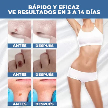 El Eliminador Definitivo de Verrugas - DermaZero + 1 GRATIS